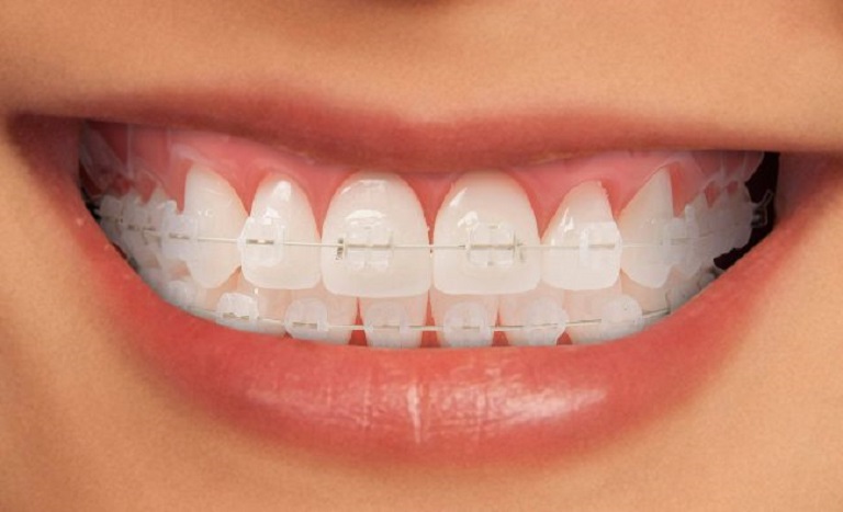Niềng Răng Mắc Cài Sứ Dây Trong: Đặc Điểm Và Bảng Giá Chi Tiết - nên niềng răng sứ hay kim loại
