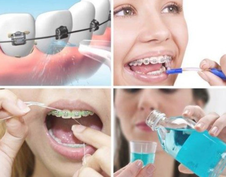 Các bước vệ sinh răng niềng hiệu quả - nên niềng răng sứ hay kim loại