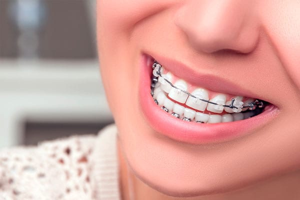 Tất tần tật về niềng răng mắc cài tự buộc - nên niềng răng sứ hay kim loại