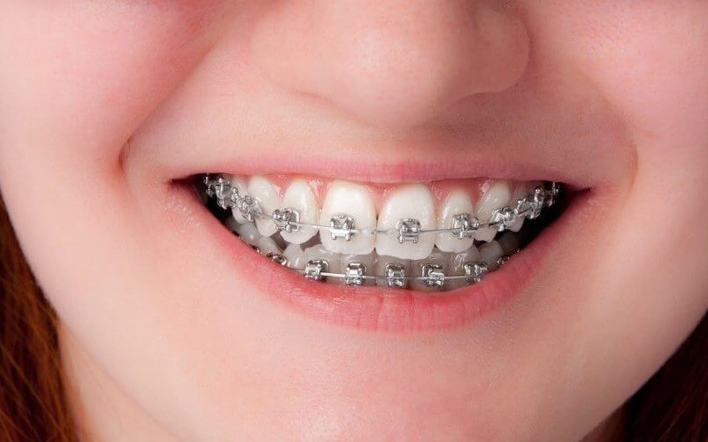 Nên niềng răng mắc cài sứ hay kim loại? | nên niềng răng sứ hay kim loại