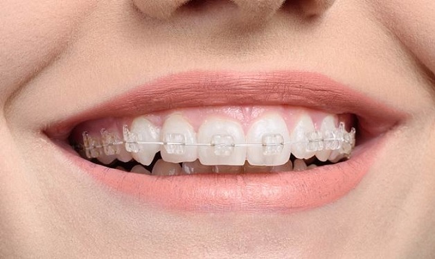 Góc giải đáp: nên niềng răng mắc cài sứ hay kim loại? | nên niềng răng sứ hay kim loại