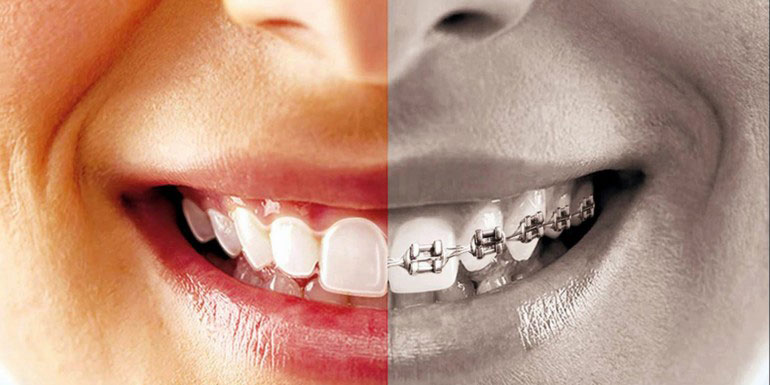 Niềng răng không mắc cài giá bao nhiêu ? nên niềng răng sứ hay kim loại