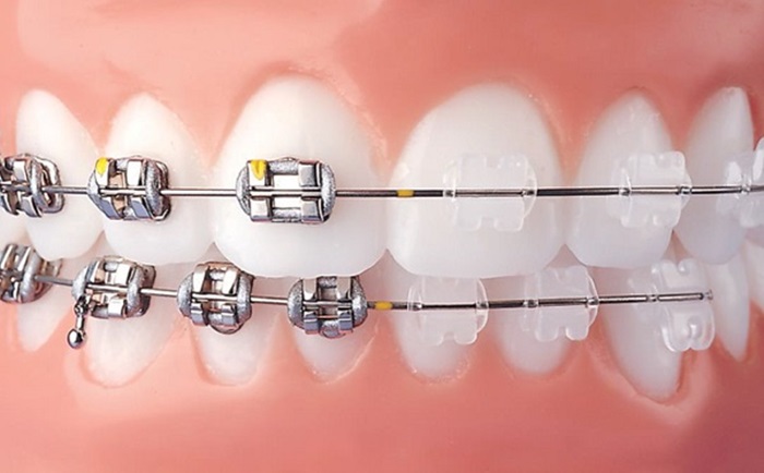 Niềng răng mắc cài sứ là giải pháp răng khỏe, thẩm mỹ cao - nên niềng răng sứ hay kim loại